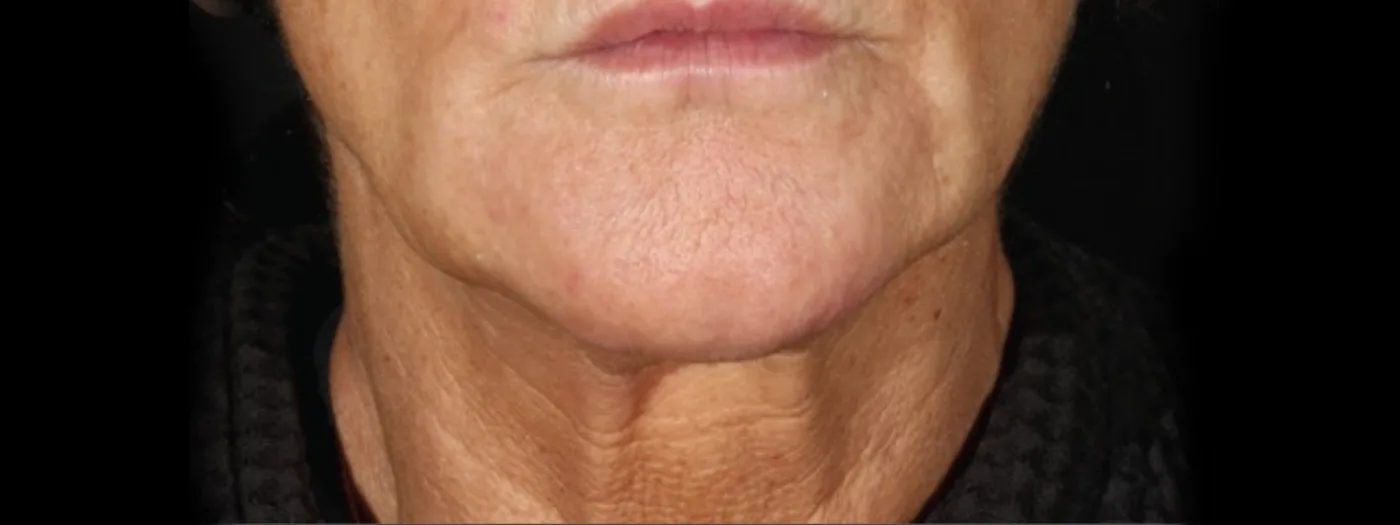 After XERF treatment