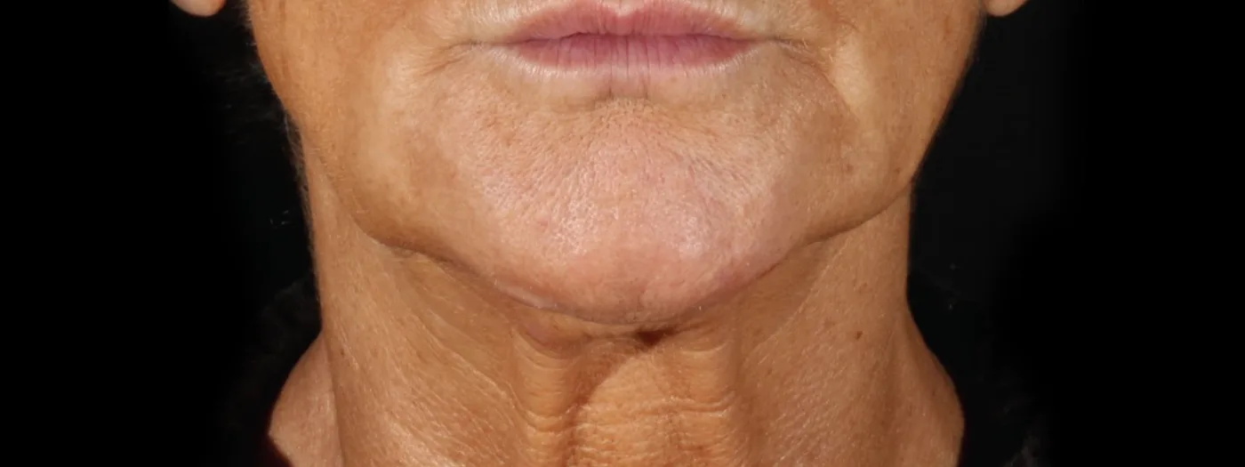 Before XERF treatment