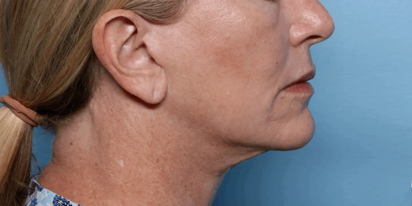 After XERF treatment