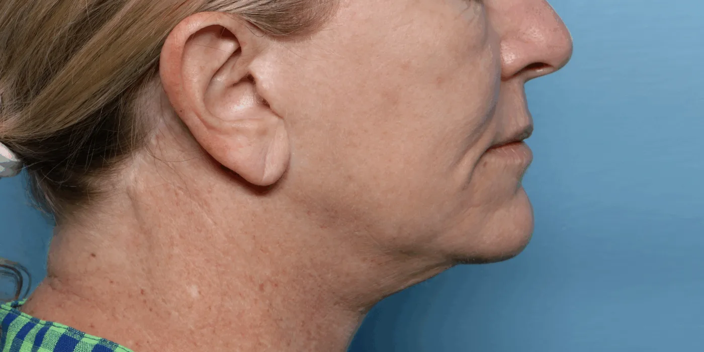 Before XERF treatment