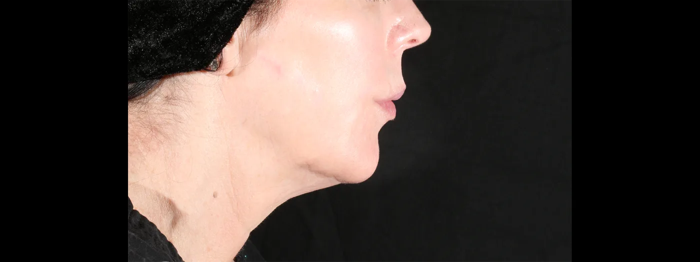 After XERF treatment