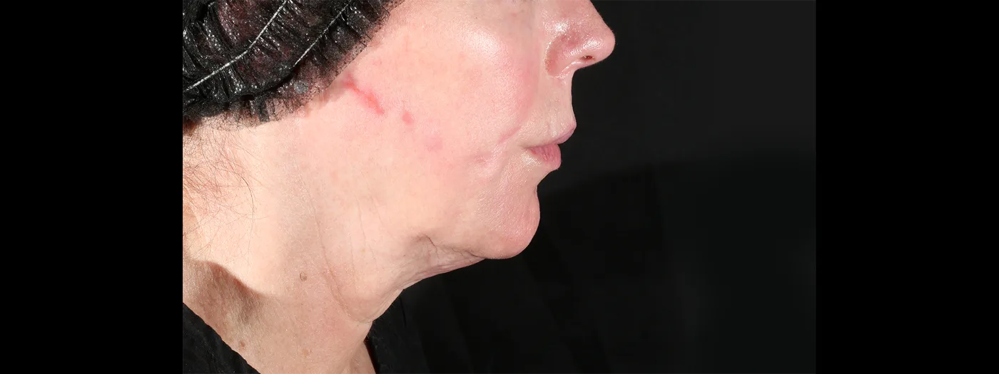 Before XERF treatment